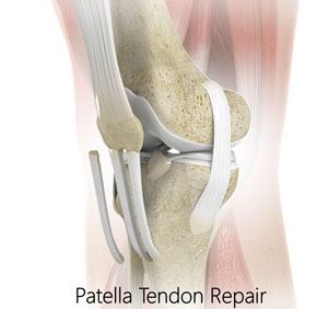 Patellar Tendon Repair