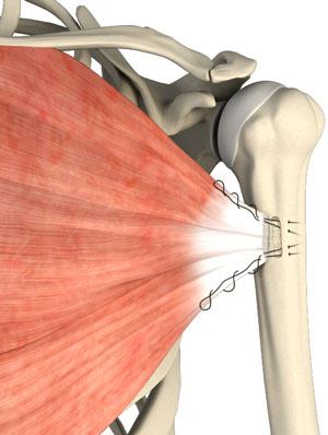 Pectoralis Tendon Repair