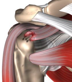 Rotator cuff 