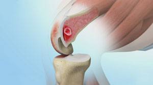 Subchondroplasty Cincinnati | Knee Osteoarthritis Treatment West Chester