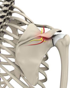 Suprascapular Nerve Decompression