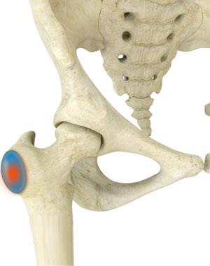 Hip Bursitis / Tendonitis — Empower